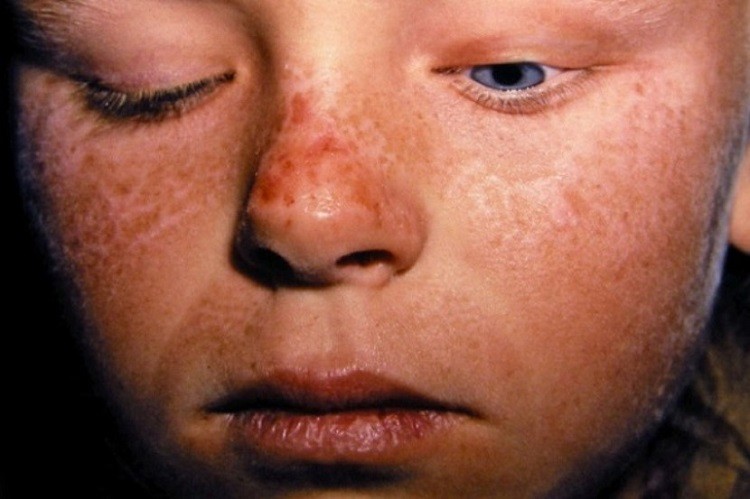 Bệnh ngoài da hiếm gặp