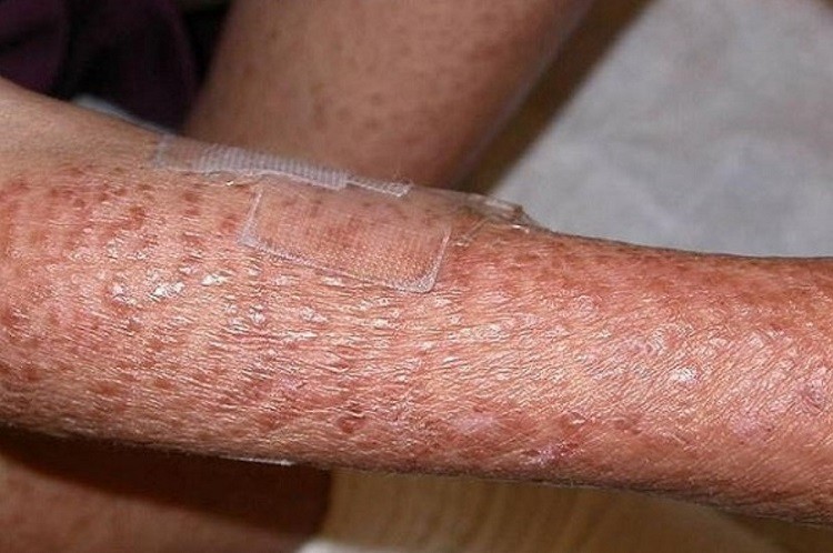 Bệnh ngoài da hiếm gặp