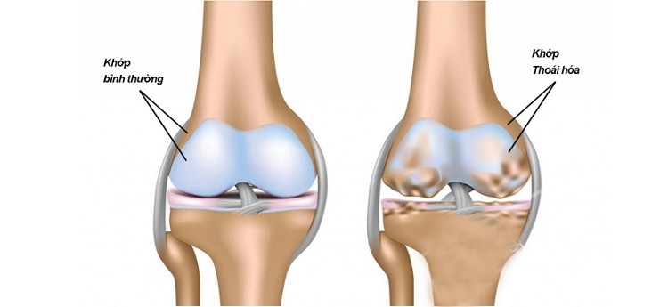 sử dụng Glucosamine đúng cách