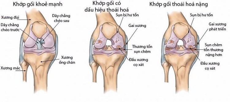 thoái hóa khớp
