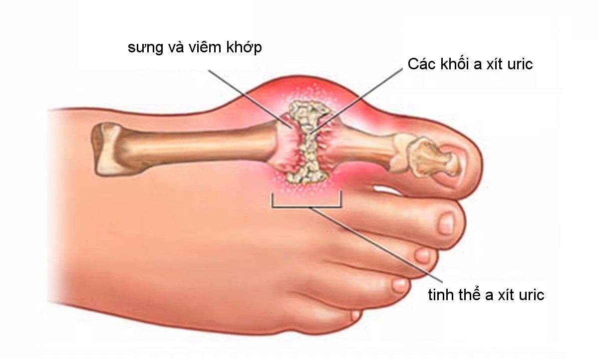 Các khớp sưng tấy, viêm