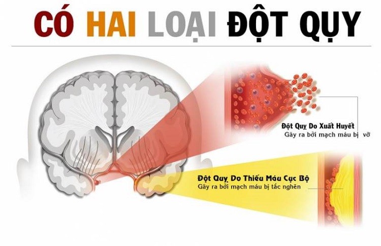 hai loại đột quỵ