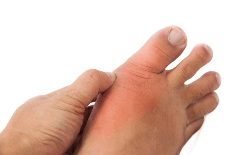 Nam giới có xu hướng dễ bị bệnh Gout hơn nữ giới