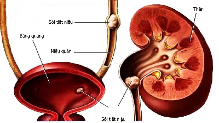 Xuất hiện sỏi urat trong thận