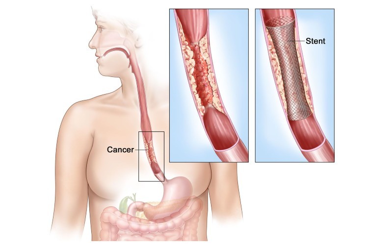 Ung thư thực quản