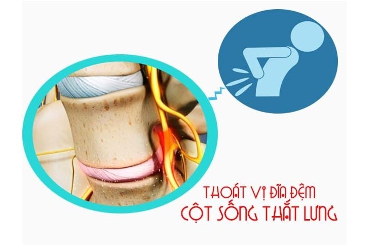thoát vị đĩa đệm là gì, triệu chứng thoát vị đĩa đệm cổ, thoát vị đĩa đệm cổ là gì, thoát vị đĩa đệm lưng là gì, bị thoát vị đĩa đệm là gì, các triệu chứng thoát vị đĩa đệm, triệu chứng của thoát vị đĩa đệm là gì, triệu chứng thoát vị đĩa đệm mông, nguyên nhân triệu chứng bệnh thoát vị đĩa đệm, bệnh thoát vị đĩa đệm là gì, chữa thoát vị đĩa đệm là gì, giá thoát vị đĩa đệm là gì, triệu chứng thoát vị đĩa đệm, triệu chứng thoát vị đĩa đệm net, triệu chứng thoát vị đĩa đệm lưng, triệu chứng thoát vị đĩa đệm nhẹ, triệu chứng thoát vị đĩa đệm đốt sống lưng, hội chứng thoát vị đĩa đệm, nguyên nhân triệu chứng thoát vị đĩa đệm, nguyên nhân và triệu chứng thoát vị đĩa đệm, chịu chứng thoát vị đĩa đệm, biến chứng thoát vị đĩa đệm