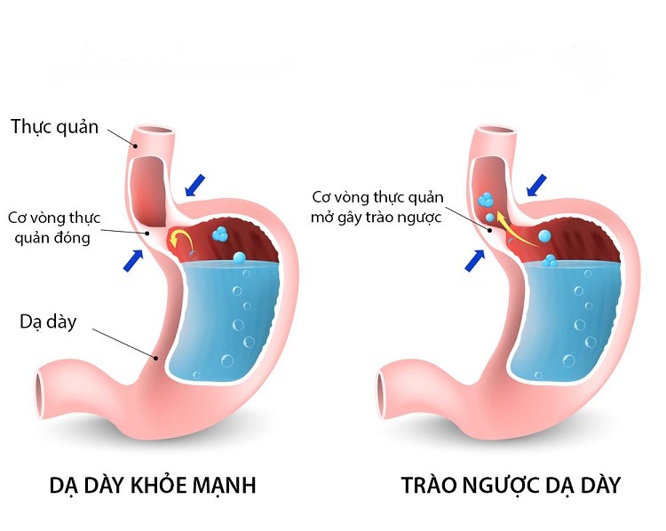 Loét thực quản hoặc hẹp thực quản