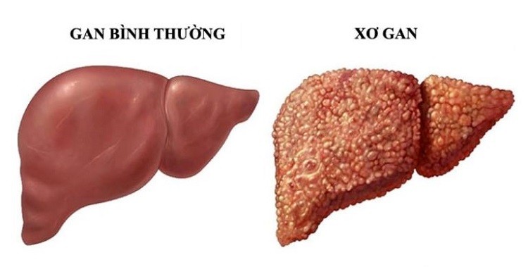 bệnh xơ gan là gì, xơ gan, bệnh xơ gan, triệu chứng xơ gan, bệnh xơ gan có chữa được không, bệnh xơ gan có lây không, điều trị xơ gan, dấu hiệu xơ gan