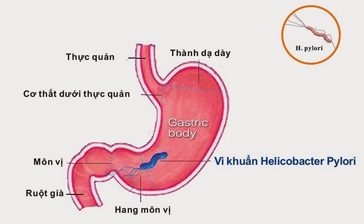 vi khuẩn HP