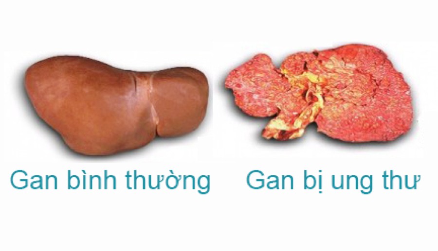 Nhu mô gan thô là gì? Những điều bạn cần biết về nhu mô gan thô  nhu mô gan thô là bệnh gì, gan nhu mô thô là gì, nhu mô gan thô có phải là xơ gan, nhu mô gan là gì, gan thô là gì, gan thô là như thế nào, nhu mô gan thô là gì, bệnh lý chủ mô gan là gì, nhu mô gan thô nhẹ là gì, gan bị thô có chữa khỏi được không