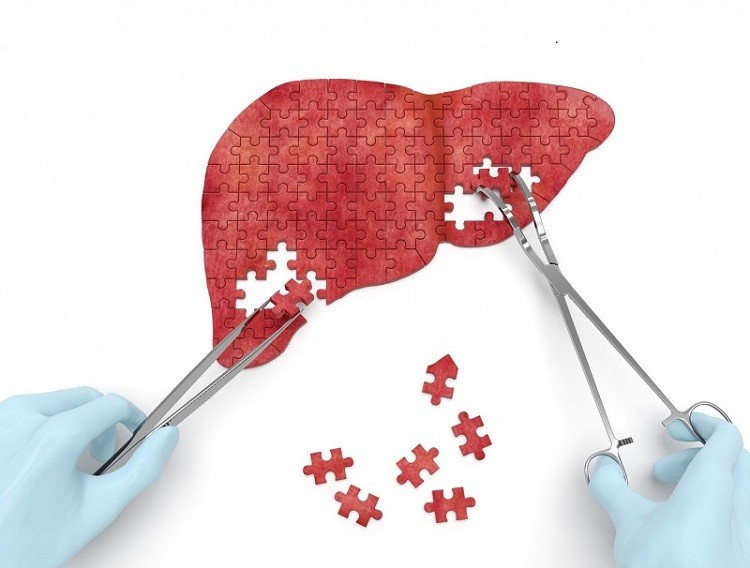bệnh xơ gan là gì, xơ gan, bệnh xơ gan, triệu chứng xơ gan, bệnh xơ gan có chữa được không, bệnh xơ gan có lây không, điều trị xơ gan, dấu hiệu xơ gan
