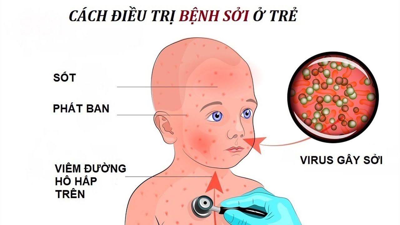 Bệnh sởi