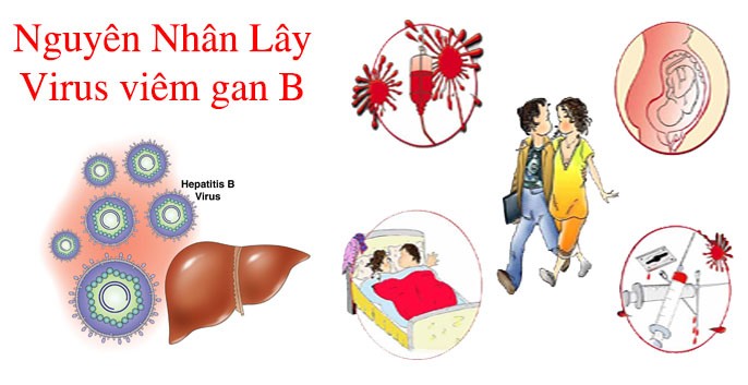 Bệnh viêm gan B là bệnh gì bệnh viêm gan B mạn là gì, bệnh viêm gan siêu vi b là gì, người lành mang bệnh viêm gan B là gì, bệnh viêm gan virus b mạn là gì, bệnh viêm gan B là bệnh gì, bệnh viêm gan B là gì, bệnh viêm gan B biểu hiện, bệnh viêm gan B dấu hiệu, bệnh viêm gan B có nguy hiểm không, bệnh viêm gan B có điều trị được không, bệnh viêm gan B có chữa được k, bệnh viêm gan B và những điều cần biết, có chữa được bệnh viêm gan B không, bệnh viêm gan B có mang thai được không, bệnh viêm gan B có dễ lây không, bệnh viêm gan B lây lan như thế nào, bệnh viêm gan B có di truyền