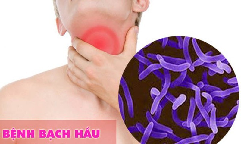 bạch hầu là gì, bệnh bạch hầu triệu chứng, Bạch hầu chữa được không, bệnh bạch hầu có lây nhiễm không, phòng ngừa bệnh bạch hầu, điều trị bệnh bạch hầu, bạch hầu đăk nông, bạch hầu ở daklak, bạch hầu ác tính, bạch hầu bệnh học, bạch hầu ho gà uốn ván, bạch hầu thanh quản, bạch hầu họng, bạch hầu ho gà uốn ván bại liệt, bạch hầu cao, bạch hầu cao ở trẻ, bạch hầu amidan, bạch hầu tiếng anh, bệnh bạch hầu có nguy hiểm không