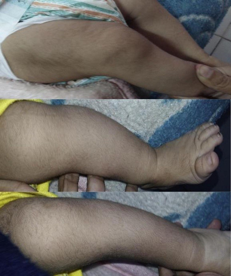 Bệnh Cantú là bệnh gì? Bệnh Cantú là bệnh gì