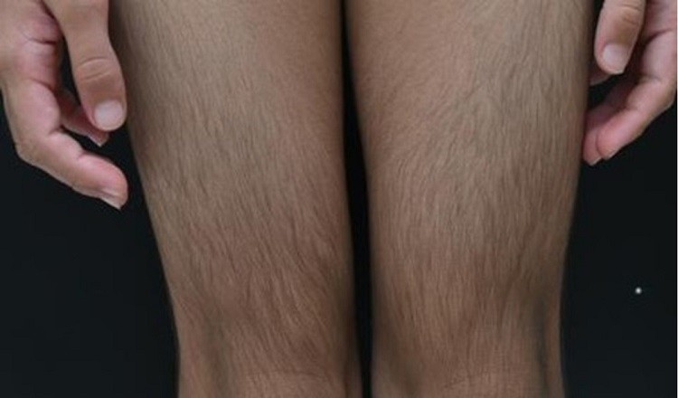 Bệnh Cantú là bệnh gì? Bệnh Cantú là bệnh gì