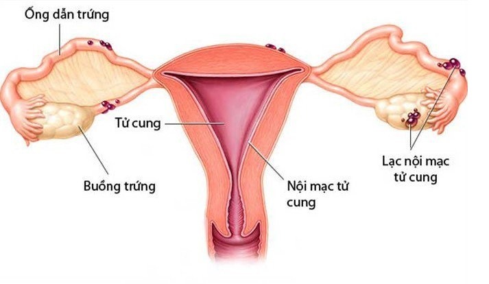 Bệnh lạc nội mạc tử cung có thể có con không, Bệnh lạc nội mạc tử cung