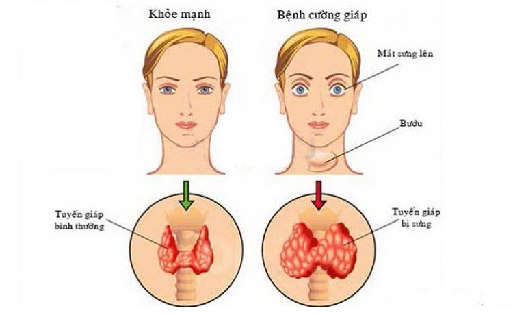 bệnh cường giáp nên ăn gì, bệnh cường giáp kiêng gì, bệnh cường giáp nên kiêng ăn gì, bệnh cường giáp nên ăn uống như thế nào