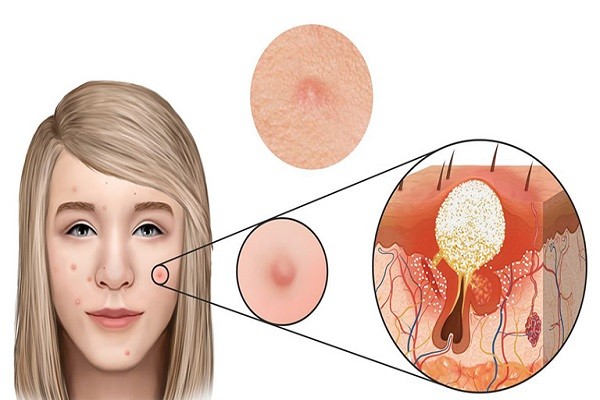 cách trị mụn tại nhà ở tuổi dậy thì, cách trị mụn tại nhà hiệu quả, cách trị mụn tại nhà bằng chanh, cách trị mụn tại nhà bằng nha đam, cách trị mụn tại nhà bằng mật ong, cách trị mụn tại nhà nhanh nhất, cách trị mụn tại nhà đơn giản, cách trị mụn tại nhà bằng rau diếp cá