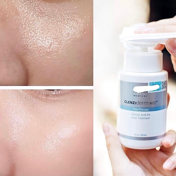 obagi clenziderm md pore therapy review, review obagi clenziderm, obagi clenziderm md pore therapy 148ml, obagi pore therapy review, obagi clenziderm là gì