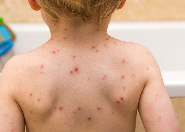 bệnh thủy đậu, bệnh thủy đậu là gì, bệnh thủy đậu có lây không, bệnh thủy đậu kiêng gì, bệnh thủy đậu có được tắm không, bệnh thủy đậu ở trẻ, bệnh thủy đậu ở trẻ em, bệnh thủy đậu tiếng anh là gì, bệnh thủy đậu có nguy hiểm không, bệnh thủy đậu tắm lá gì